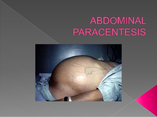 paracentesis ppt